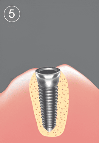 Tandköttet sys ihop kring det nyinsatta implantatet för att möjliggöra optimal läkning.
