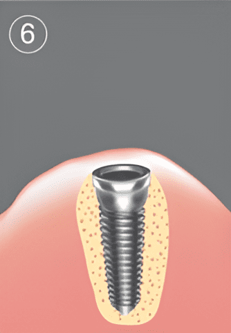 Tandköttet sys över implantatet för täckt läkning under den kommande osseointegrationen.