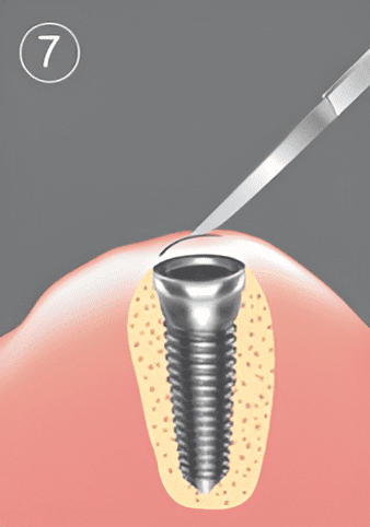 Efter läkning öppnas tandköttet för att frilägga implantatet inför digital avtryckstagning.