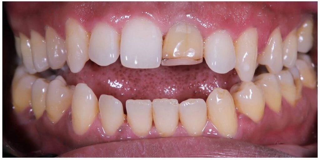 Aligners - öppet bett samt skadad och missfärgad framtand