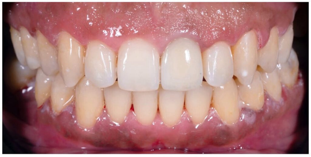 Aligners - resultat efter behandling i 24 månader